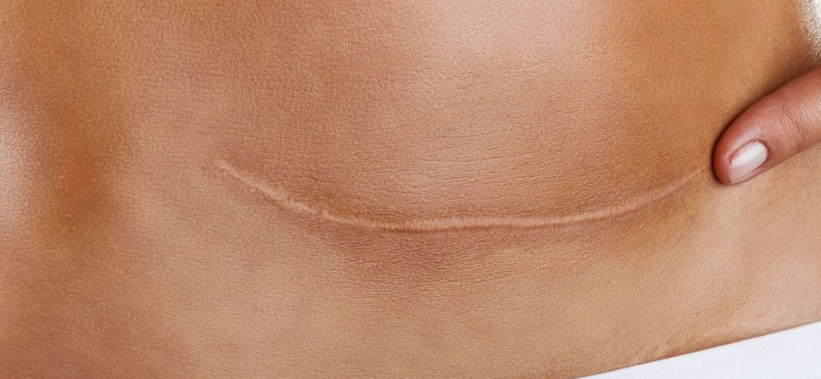 cicatrice-TECAR-terapia