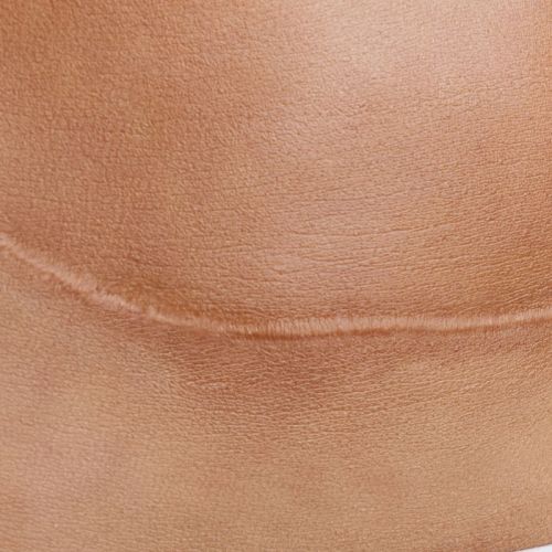 cicatrice-TECAR-terapia