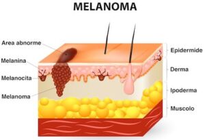 Melanoma